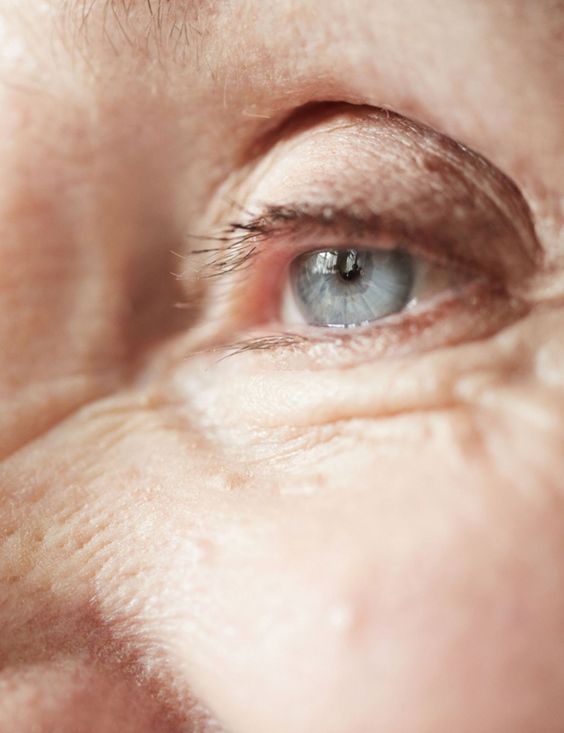 How to Prevent Age-Related Macular Degeneration (AMD)
